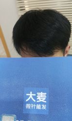 -大麦微针植发丨全国连锁