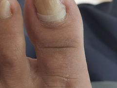 -世龙世家灰指甲鸡眼脚气甲沟炎跖疣护理(通州店)