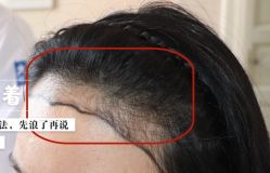 -大麦微针植发全国连锁