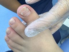 -Andrew指甲专科灰指甲·甲沟炎矫正·3D步态矫形鞋垫定制(浦三路店)