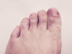 第六周-派恩宜灰指甲鸡眼嵌甲手足癣