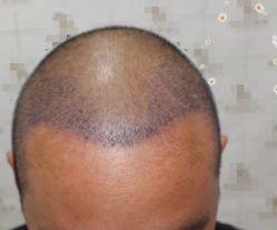 -大麦微针植发丨全国连锁