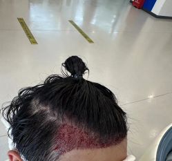 -大麦微针植发全国连锁