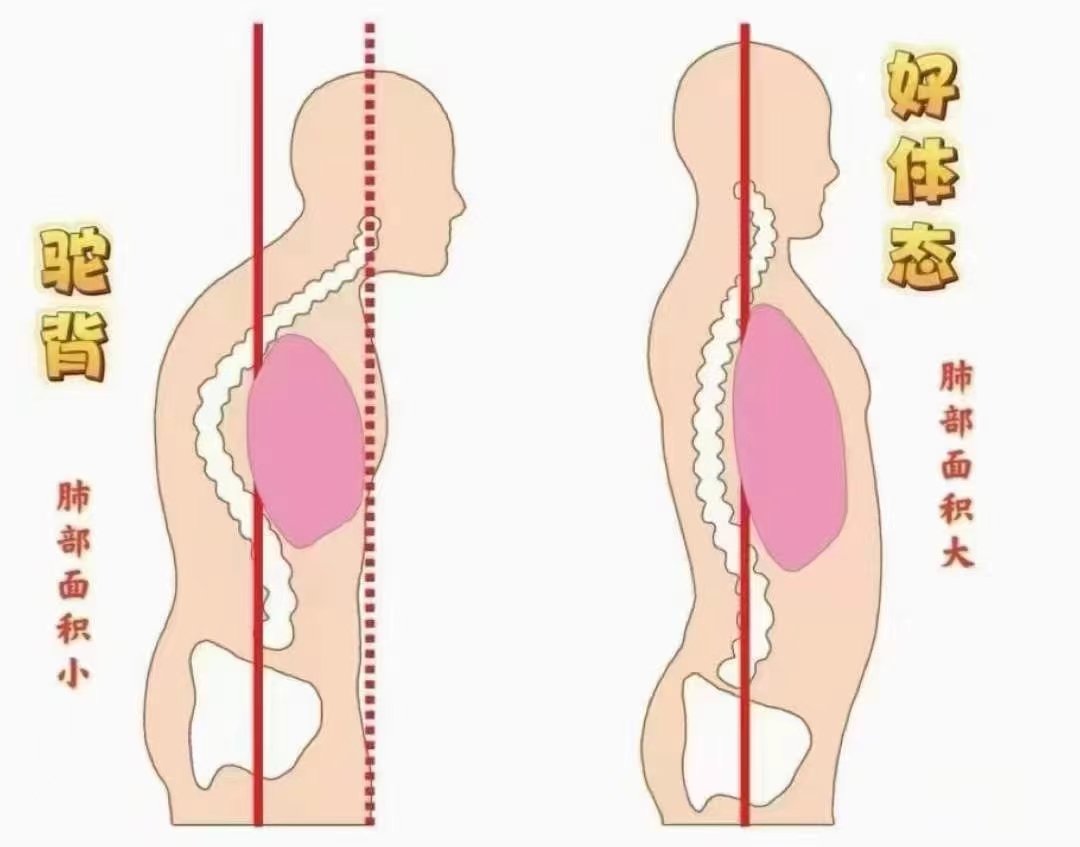 弓背和驼背的区别图图片