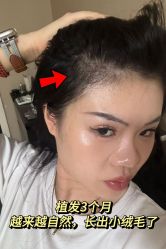 -碧莲盛·不剃发植发