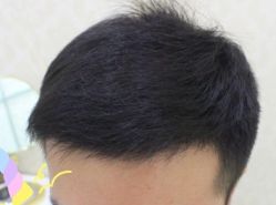 -大麦微针植发丨全国连锁