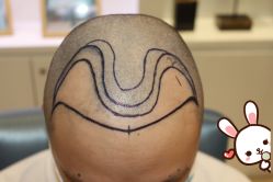 -大麦微针植发丨全国连锁