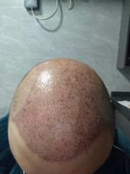 -碧莲盛·不剃发植发