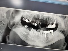 -上海仁爱医院口腔科 · 种植