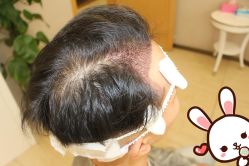 点击看大图 -大麦微针植发丨全国连锁