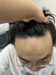 -大麦微针植发全国连锁