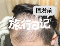 -大麦微针植发全国连锁