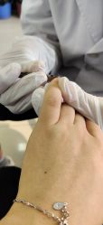 -德哥灰指甲脚气甲沟炎跖疣护理