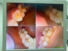 -上海仁爱医院口腔科 · 种植