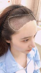 -大麦微针植发丨全国连锁