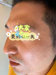 -爱莎扁平疣·汗管瘤·斑痣中心