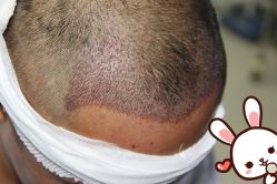 点击看大图 -大麦微针植发丨全国连锁