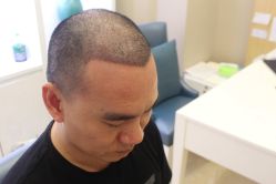 点击看大图 -大麦微针植发丨全国连锁