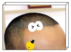 -大麦微针植发全国连锁