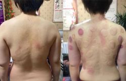 -苗塑堂减肥艾灸