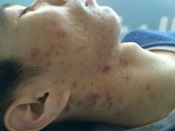 android_upload_pic-韩医生专业祛痘连锁机构