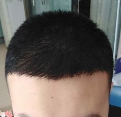 -大麦微针植发丨全国连锁