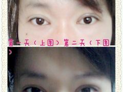 第一天和第二天-上海华安整形外科门诊部