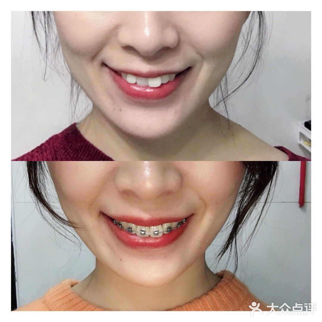 带牙套5个多月了，变化还是挺明显的