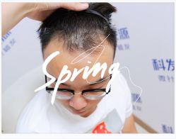 点击看大图 体验后-大麦微针植发全国连锁