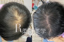 -RC半永久纹眉纹发际线