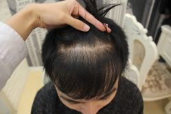 点击看大图 -大麦微针植发丨全国连锁