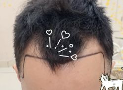 -大麦微针植发全国连锁