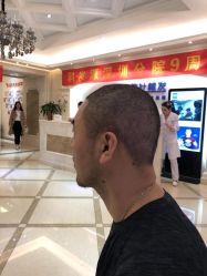 -大麦微针植发丨全国连锁