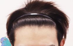 -大麦微针植发丨全国连锁