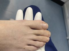 -Andrew指甲专科灰指甲·甲沟炎矫正·3D步态矫形鞋垫定制(上海法华镇路旗舰店)