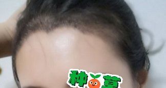 -大麦微针植发丨全国连锁