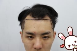 -大麦微针植发丨全国连锁