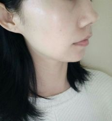 -爱莎扁平疣·汗管瘤·斑痣中心