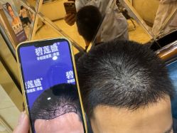 -碧莲盛·不剃发植发