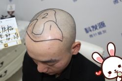 点击看大图 -大麦微针植发丨全国连锁