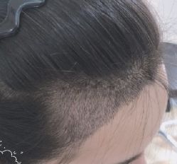 -大麦微针植发丨全国连锁