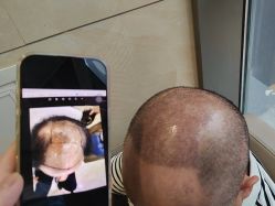 -碧莲盛·不剃发植发