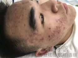 体验后-蕾特恩专业祛痘·皮肤管理