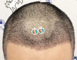 -大麦微针植发全国连锁