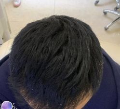 -大麦微针植发丨全国连锁