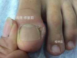 -德哥灰指甲脚气甲沟炎跖疣护理