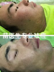 -苗医生0感祛痘连锁
