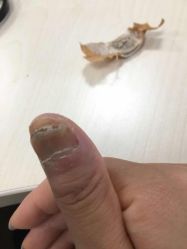 点击看大图 -德哥灰指甲脚气甲沟炎跖疣护理