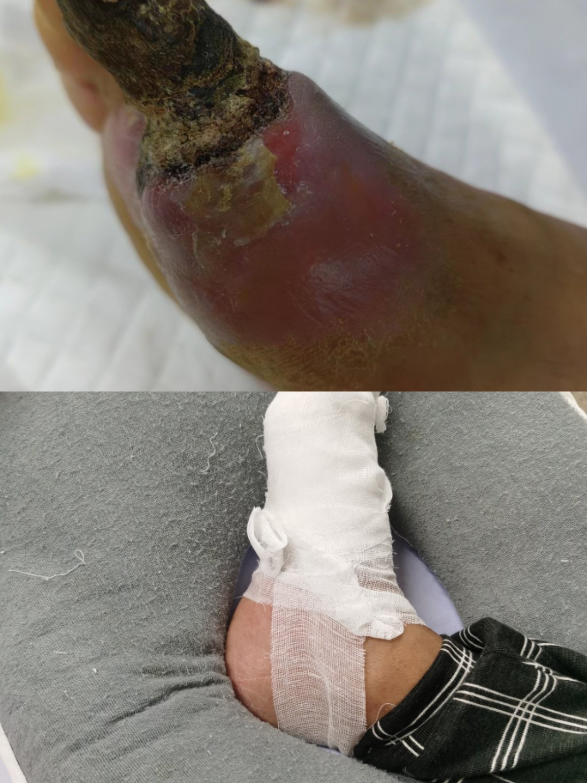 修脚破皮了会得病么