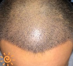 -大麦微针植发丨全国连锁